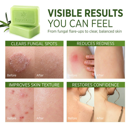 RoyceDerm Tea Tree Oil Antifungal Soap – Daily Gentle Cleansing & Antifungal Care