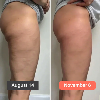 Smoother Skin & Lighter Legs in 30 Days