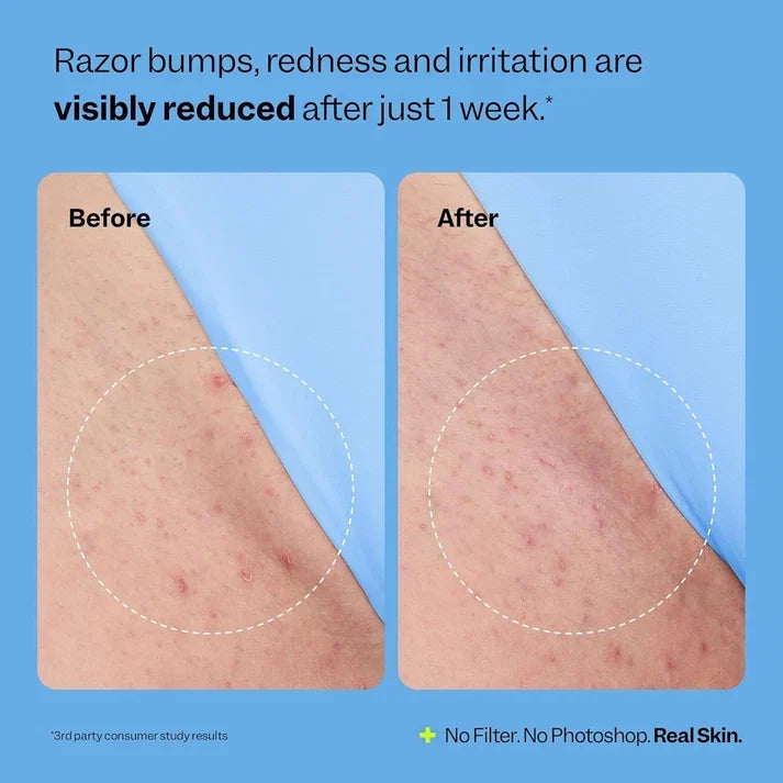 Smoothing Solution Ingrown Hair Treatment