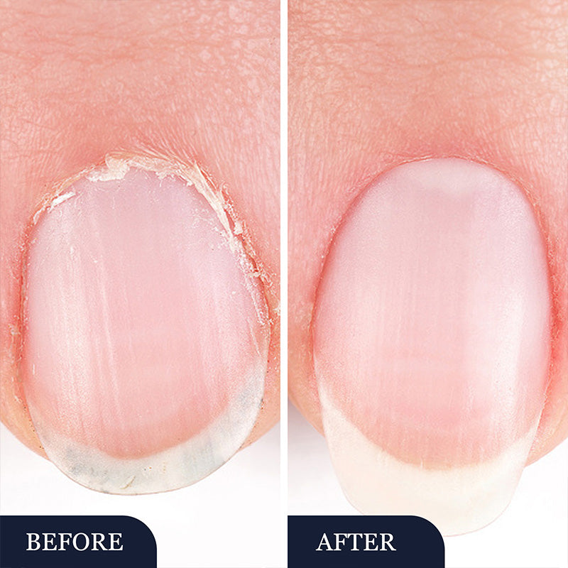 🖤2026 New Year · 40% OFF🖤Toenail Fungus Treatment Pen for Damaged Nails