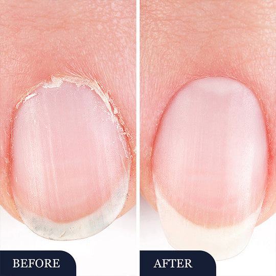 🖤2026 New Year · 40% OFF🖤Toenail Fungus Treatment Pen for Damaged Nails