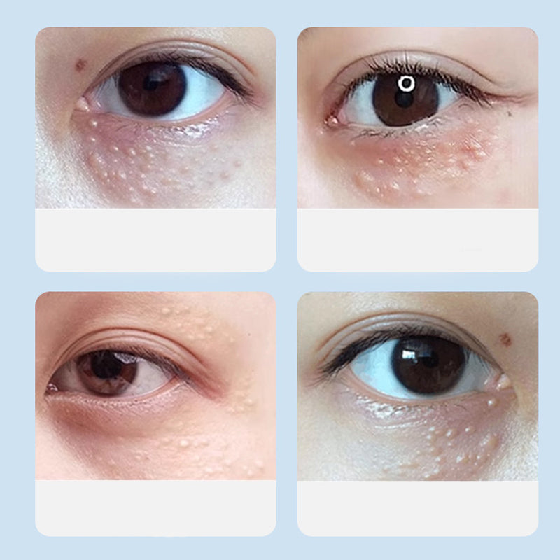 Advanced Milia Remover Serum