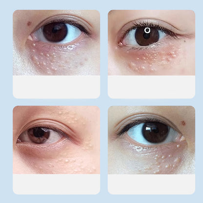 Advanced Milia Remover Serum