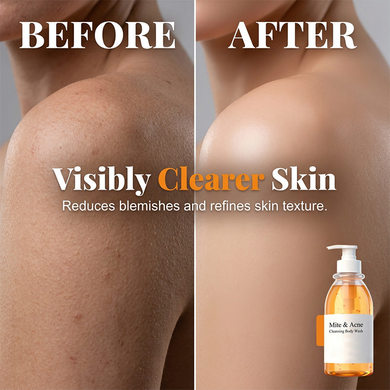 Anti-Mite & Acne Control Body Wash